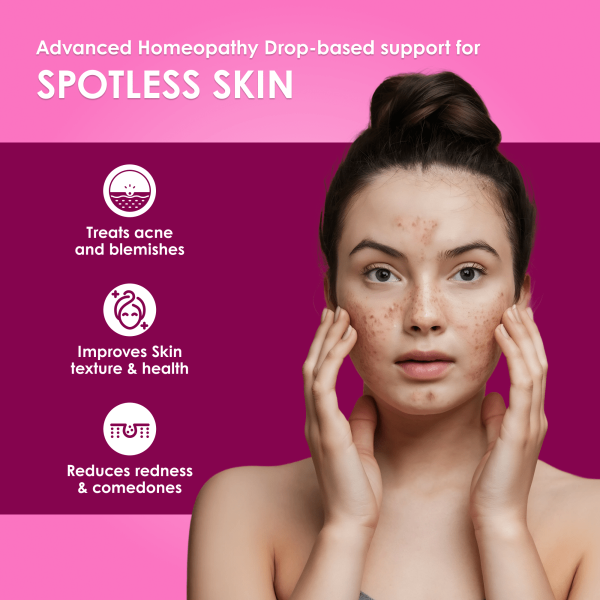 Acnedonna Advanced Homeopathy 2.0 for Acne, Pimples & Skin Clarity Support | Oral Drops | 30ml - Meethi Golee